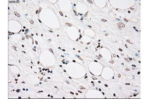 Immunohistochemical staining of paraffin-embedded Carcinoma of kidney tissue using anti-PLK1mouse monoclonal antibody. (PLK1 Antikörper)
