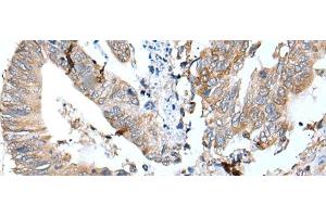 Immunohistochemistry of paraffin-embedded Human colorectal cancer tissue using GKN1 Polyclonal Antibody at dilution of 1:30(x200) (Gastrokine 1 Antikörper)