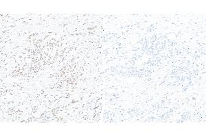 Immunohistochemistry (IHC) image for anti-Signal Transducer and Activator of Transcription 3 (Acute-Phase Response Factor) (STAT3) (pTyr705) antibody (ABIN7453986)