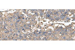 Immunohistochemistry of paraffin-embedded Human liver cancer tissue using BLOC1S6 Polyclonal Antibody at dilution of 1:95(x200) (Pallidin Antikörper)