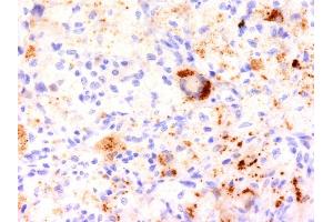 Formalin-fixed, paraffin-embedded human Erdheim-Chester disease (also known as polyostotic sclerosing histiocytosis) stained with TNF alpha Monoclonal Antibody (TNF706).