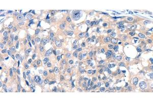 Immunohistochemistry of paraffin-embedded Human breast cancer tissue using GRIN2D Polyclonal Antibody at dilution 1:30 (GRIN2D Antikörper)