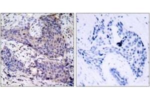 Immunohistochemistry analysis of paraffin-embedded human breast carcinoma tissue, using BAD (Ab-136) Antibody. (BAD Antikörper  (AA 102-151))