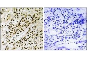 Immunohistochemistry analysis of paraffin-embedded human breast carcinoma, using MAPKAPK5 (Phospho-Thr182) Antibody. (MAPKAP Kinase 5 Antikörper  (pThr182))