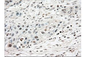 Immunohistochemical staining of paraffin-embedded Carcinoma of pancreas tissue using anti-TYRO3mouse monoclonal antibody. (TYRO3 Antikörper)