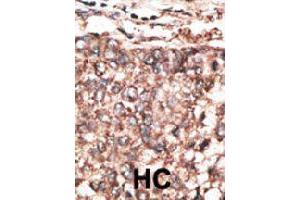 Immunohistochemical staining (Formalin-fixed paraffin-embedded sections) of human hepatocarcinoma. (PDGFD Antikörper  (AA 313-341))
