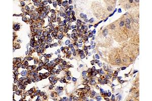 Immunohistochemistry analysis of paraffin-embedded human stomach cancer using CD192 Polyclonal Antibody at dilution of 1:300. (CCR2 Antikörper)