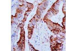 Immunohistochemical analysis of paraffin embedded Mammary cancer sections, staining MAPK1-3 in cytoplasm and nucleus, DAB chromogenic reaction (ERK1/2 Antikörper  (N-Term))
