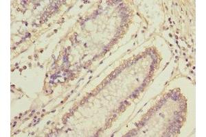 Immunohistochemistry of paraffin-embedded human colon cancer using ABIN7160476 at dilution of 1:100 (MLF1 Antikörper  (AA 1-268))