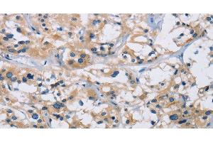 Immunohistochemistry of paraffin-embedded Human thyroid cancer using IL17RB Polyclonal Antibody at dilution of 1:40 (IL17 Receptor B Antikörper)