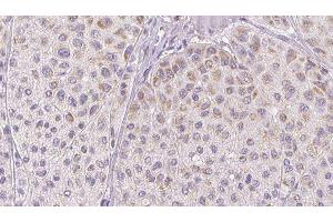 ABIN6277763 at 1/100 staining Human melanoma tissue by IHC-P. (CCL2 Antikörper  (Internal Region))