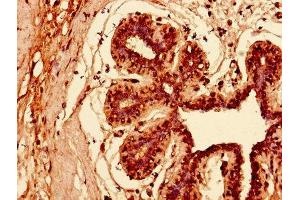 Immunohistochemistry of paraffin-embedded human breast cancer using ABIN7157408 at dilution of 1:100