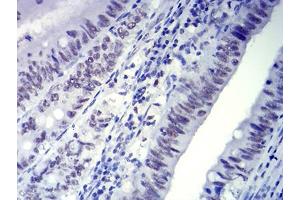 Immunohistochemical analysis of paraffin-embedded rectum cancer tissues using CTNNBL1 mouse mAb with DAB staining. (CTNNBL1 Antikörper  (AA 390-557))