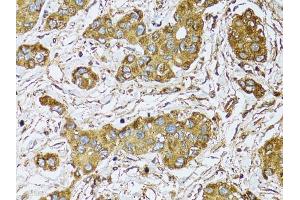 Immunohistochemistry of paraffin-embedded human liver cancer using μgDH antibody (ABIN5970552) at dilution of 1/100 (40x lens). (UGDH Antikörper)