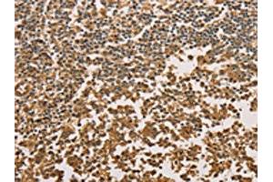 The image on the left is immunohistochemistry of paraffin-embedded Human tonsil tissue using ABIN7131042(SETD2 Antibody) at dilution 1/40, on the right is treated with fusion protein. (SETD2 Antikörper)
