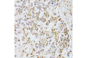 Immunohistochemistry of paraffin-embedded human lung cancer using AIFM3 antibody (ABIN5996156) at dilution of 1/100 (40x lens). (AIFM3 Antikörper)