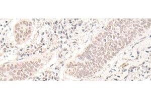 Immunohistochemistry of paraffin-embedded Human esophagus cancer tissue using ZBED1 Polyclonal Antibody at dilution of 1:40(x200) (ZBED1 Antikörper)