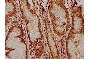 IHC image of ABIN7174271 diluted at 1:400 and staining in paraffin-embedded human gastric cancer performed on a Leica BondTM system. (USP17L5 Antikörper  (C-Term))