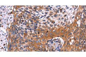Immunohistochemistry of paraffin-embedded Human cervical cancer using RDX Polyclonal Antibody at dilution of 1:60 (Radixin Antikörper)