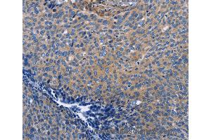 Immunohistochemistry of Human cervical cancer using INTS10 Polyclonal Antibody at dilution of 1:50 (INTS10 Antikörper)