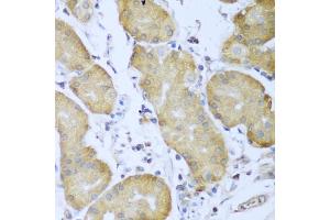 Immunohistochemistry of paraffin-embedded human gastric cancer using IGF2BP3 antibody (ABIN5971465) at dilution of 1/100 (40x lens).