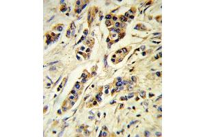 Formalin-fixed and paraffin-embedded human breast carcinoma reacted with IL10 Antibody (Center), which was peroxidase-conjugated to the secondary antibody, followed by DAB staining. (IL-10 Antikörper  (AA 27-53))