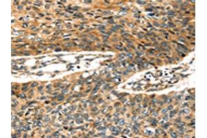 The image on the left is immunohistochemistry of paraffin-embedded Human esophagus cancer tissue using ABIN7128026(STX19 Antibody) at dilution 1/35, on the right is treated with fusion protein. (Syntaxin 19 Antikörper)