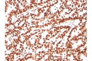Formalin-fixed, paraffin-embedded human Breast Carcinoma stained with Estrogen Receptor alpha Mouse Monoclonal Antibody (ESR1/3559). (Estrogen Receptor alpha Antikörper  (AA 129-312))
