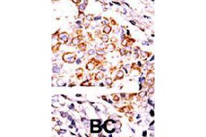 Formalin-fixed and paraffin-embedded human cancer tissue reacted with NME3 polyclonal antibody  , which was peroxidase-conjugated to the secondary antibody, followed by DAB staining. (NME3 Antikörper  (Internal Region))