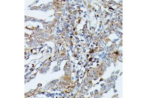 Immunohistochemistry of paraffin-embedded human lung cancer using MEKK3 antibody (ABIN7268652) at dilution of 1:100 (40x lens).