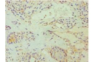 Immunohistochemistry of paraffin-embedded human breast cancer using ABIN7172529 at dilution of 1:100 (E2F6 Antikörper  (AA 1-281))