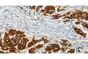 Immunohistochemistry of paraffin-embedded Human colon cancer using ADCY3 Polyclonal Antibody at dilution of 1:50 (ADCY3 Antikörper)