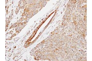 IHC-P Image Immunohistochemical analysis of paraffin-embedded human lung SCC, using HSP22, antibody at 1:500 dilution. (HSPB8 Antikörper  (C-Term))