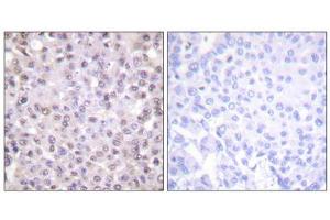 Immunohistochemistry analysis of paraffin-embedded human breast carcinoma, tissue using NCoR1 antibody. (NCOR1 Antikörper  (N-Term))