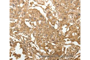 Immunohistochemistry of Human lung cancer using TXN Polyclonal Antibody at dilution of 1:40