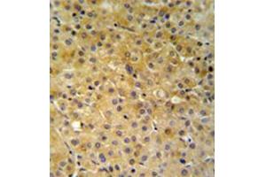 Immunohistochemistry analysis in formalin fixed and paraffin embedded hepatocarcinoma reacted with NDUFA10 Antibody (Center) followed which was followed by peroxidase conjugated to the secondary antibody and DAB staining.