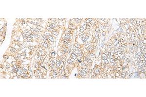 Immunohistochemistry of paraffin-embedded Human gastric cancer tissue using NME4 Polyclonal Antibody at dilution of 1:45(x200) (NME4 Antikörper)