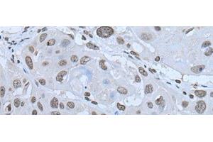 Immunohistochemistry of paraffin-embedded Human esophagus cancer tissue using HAND1 Polyclonal Antibody at dilution of 1:30(x200) (HAND1 Antikörper)