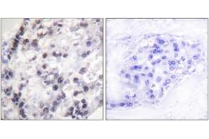 Immunohistochemistry analysis of paraffin-embedded human breast carcinoma tissue, using hnRNP C1/2 (Ab-260) Antibody. (HNRNPC Antikörper  (AA 231-280))