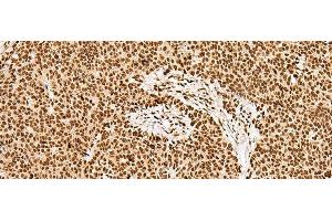 Immunohistochemistry of paraffin-embedded Human ovarian cancer tissue using GRSF1 Polyclonal Antibody at dilution of 1:30(x200) (GRSF1 Antikörper)