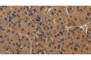 Immunohistochemistry of paraffin-embedded Human liver cancer using CD242 Polyclonal Antibody at dilution of 1:50 (ICAM4 Antikörper)