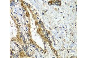 Immunohistochemistry of paraffin-embedded Human liver cancer using CDC16 Polyclonal Antibody at dilution of 1:100 (40x lens). (CDC16 Antikörper)