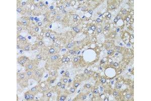 Immunohistochemistry of paraffin-embedded Human liver damage using AARS2 Polyclonal Antibody at dilution of 1:100 (40x lens). (AARS2 Antikörper)