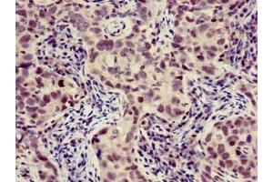 Immunohistochemistry of paraffin-embedded human pancreatic cancer using ABIN7175883 at dilution of 1:100 (XBP1 Antikörper  (AA 1-167))