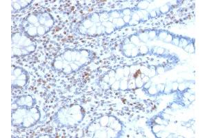 Formalin-fixed, paraffin-embedded human Colon Carcinoma stained with BMI1-Monospecific Mouse Monoclonal Antibody (BMI1/2689). (BMI1 Antikörper  (AA 142-326))