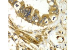 Immunohistochemistry of paraffin-embedded Human liver cancer using GBP1 Polyclonal Antibody at dilution of 1:100 (40x lens). (GBP1 Antikörper)