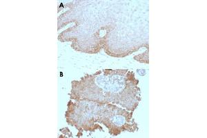 Immunohistochemical staining (Formalin-fixed paraffin-embedded sections) of human cervical carcinoma (A) and human bladder carcinoma (B) with FAT2 monoclonal antibody, clone 8C5 . (FAT Atypical Cadherin 2 (FAT2) Antikörper)