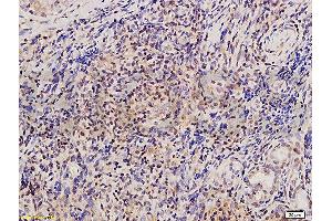 Formalin-fixed and paraffin embedded human nasopharyngeal carcinoma tissue labeled with Anti-Twist Polyclonal Antibody , and DAB staining (TWIST1, TWIST2 (AA 71-170) Antikörper)