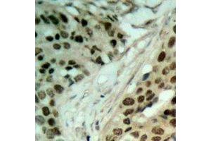 Immunohistochemical analysis of NAT5 staining in human ovarian cancer formalin fixed paraffin embedded tissue section. (NAT5 Antikörper)