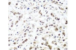 Immunohistochemistry of paraffin-embedded Human gastric cancer using HIRA Polyclonal Antibody at dilution of 1:100 (40x lens). (HIRA Antikörper)